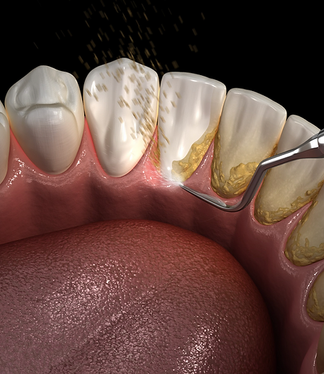 Détartrage sur dents du bas