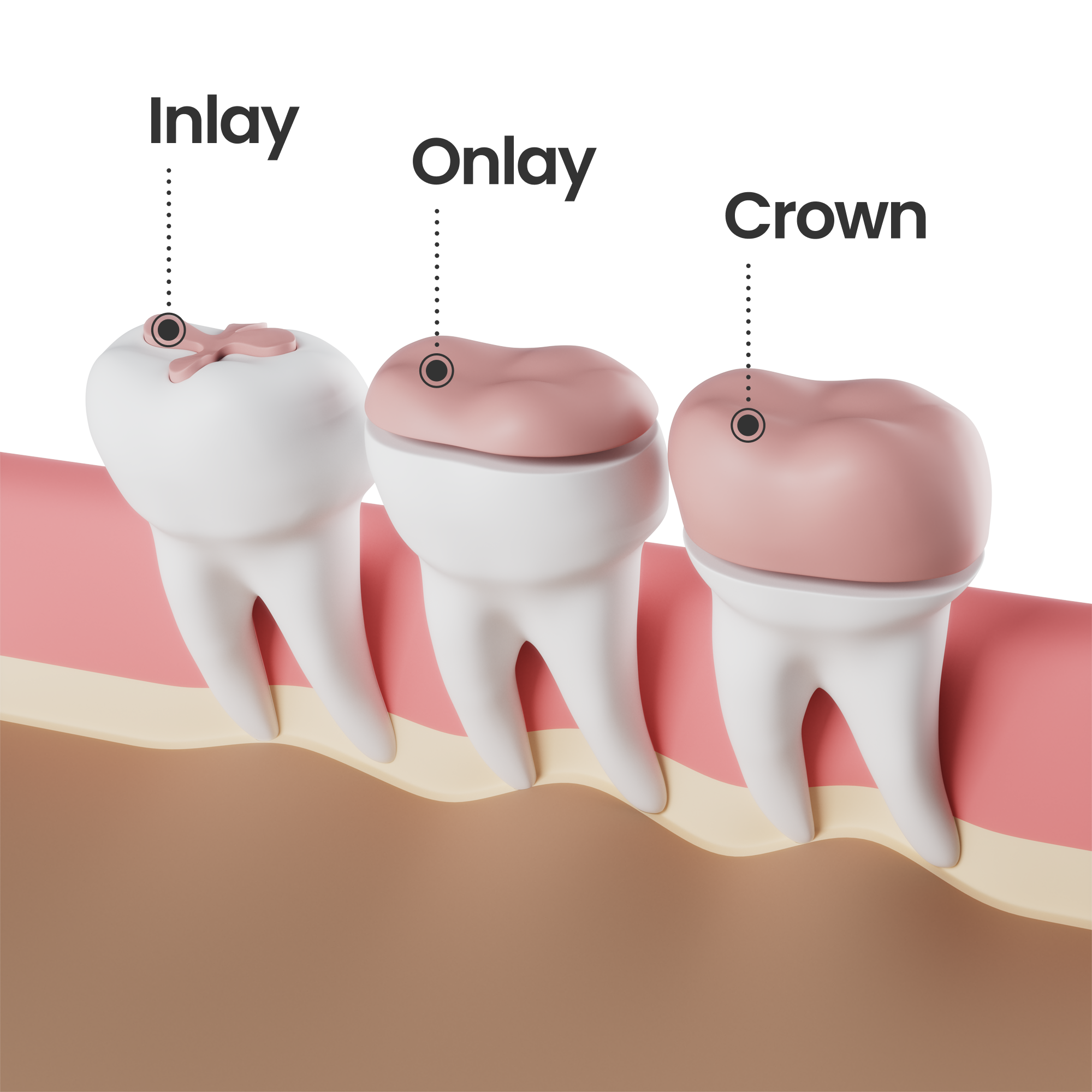 Inlay Onlay différence 2