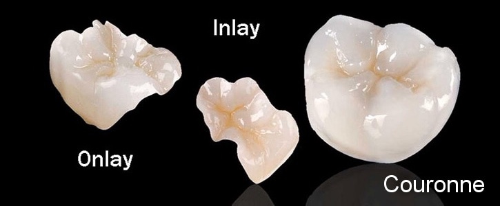 Inlay Onlay différence