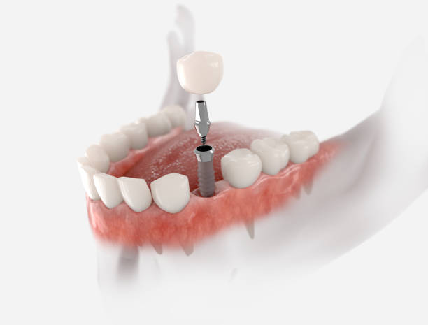 Prothèse dentaire sur implant