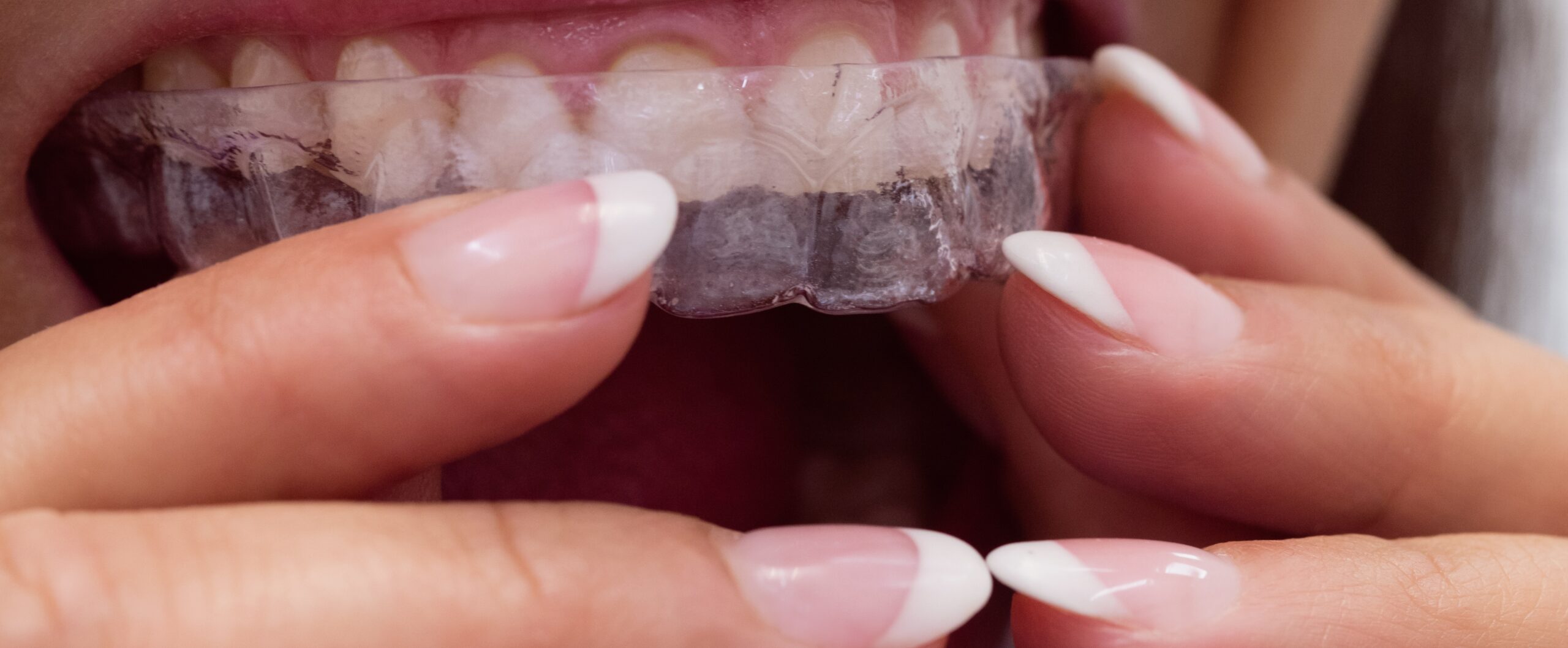 Gouttières transparentes réalignement Invisalign